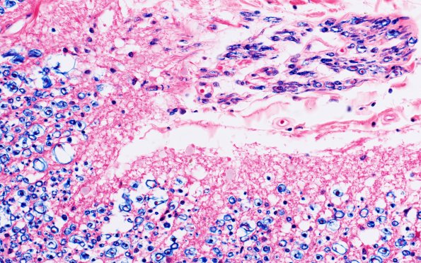 1A8 Schwannian Remyelination (Case 1) normal root exit zone Solochrome cyanine 40X