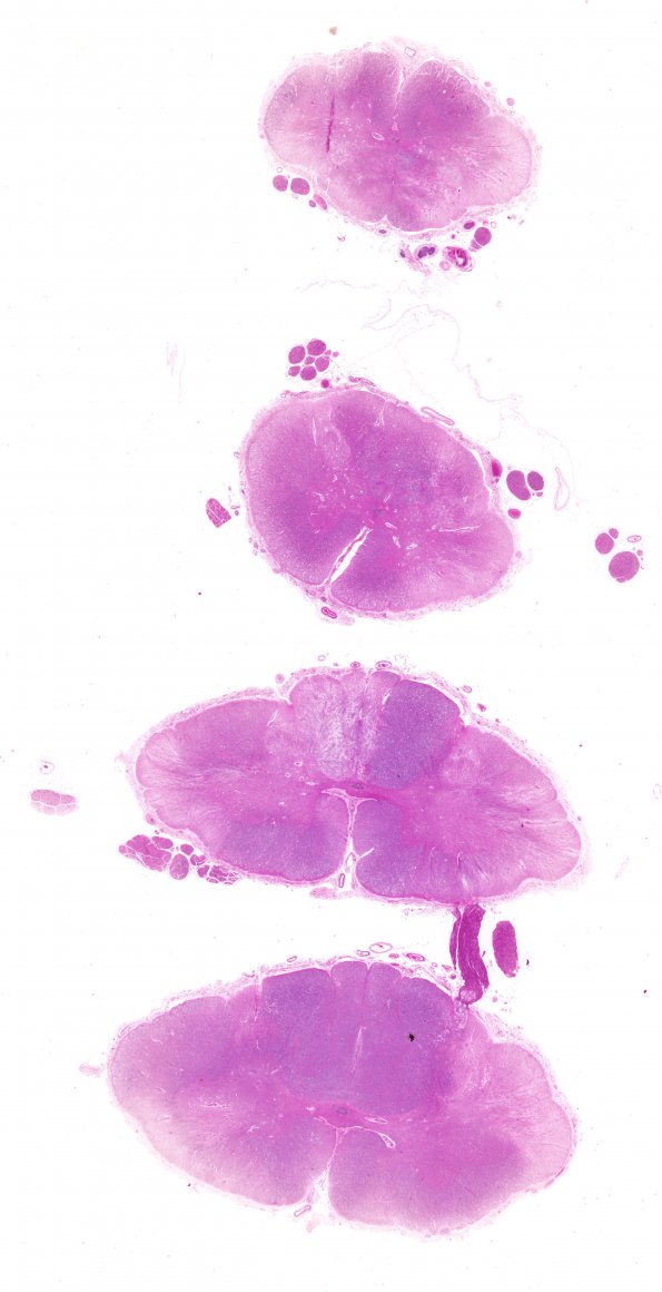 1B1 MS, Schwannian remyelination (Case 1) Solochrome cyanine WM