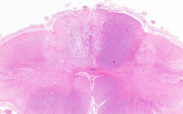 1B2 Schwannian Remyelination (Case 1) H&E 2X match with A