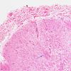 1B3 Schwannian Remyelination (Case 1) H&E 10X match with A copy