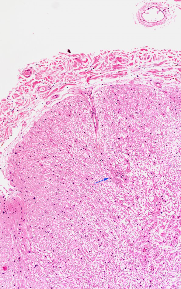 1B3 Schwannian Remyelination (Case 1) H&E 10X match with A copy