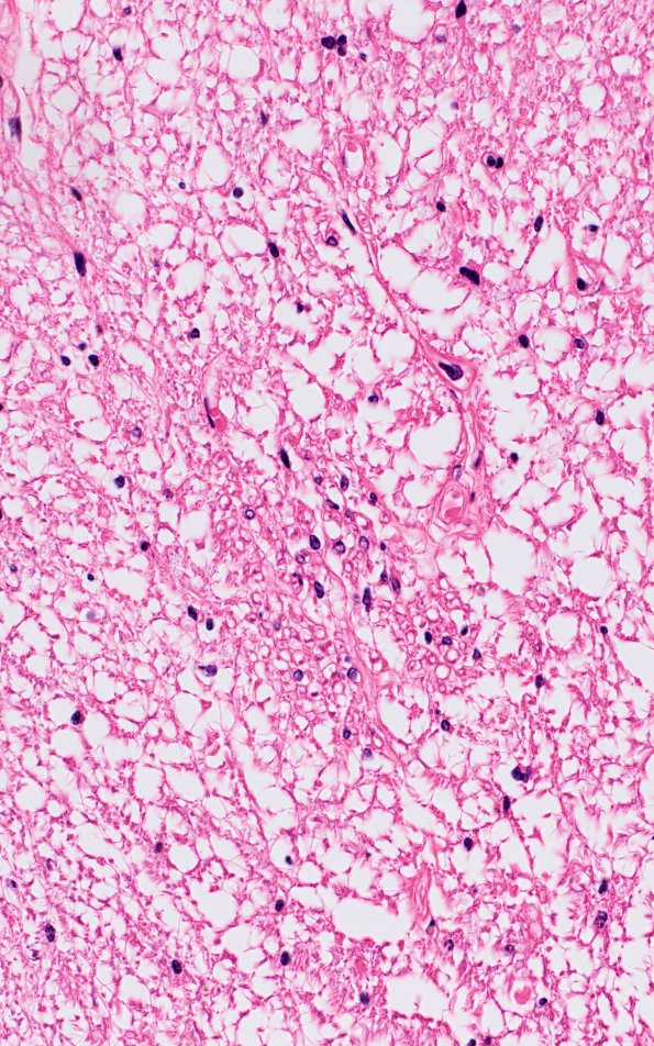 1B4 Schwannian Remyelination (Case 1) H&E 40X