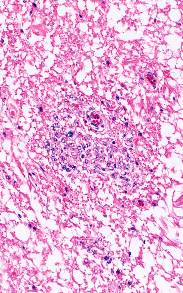 1B6 Schwannian Remyelination (Case 1) Solochrome cyanine 40X