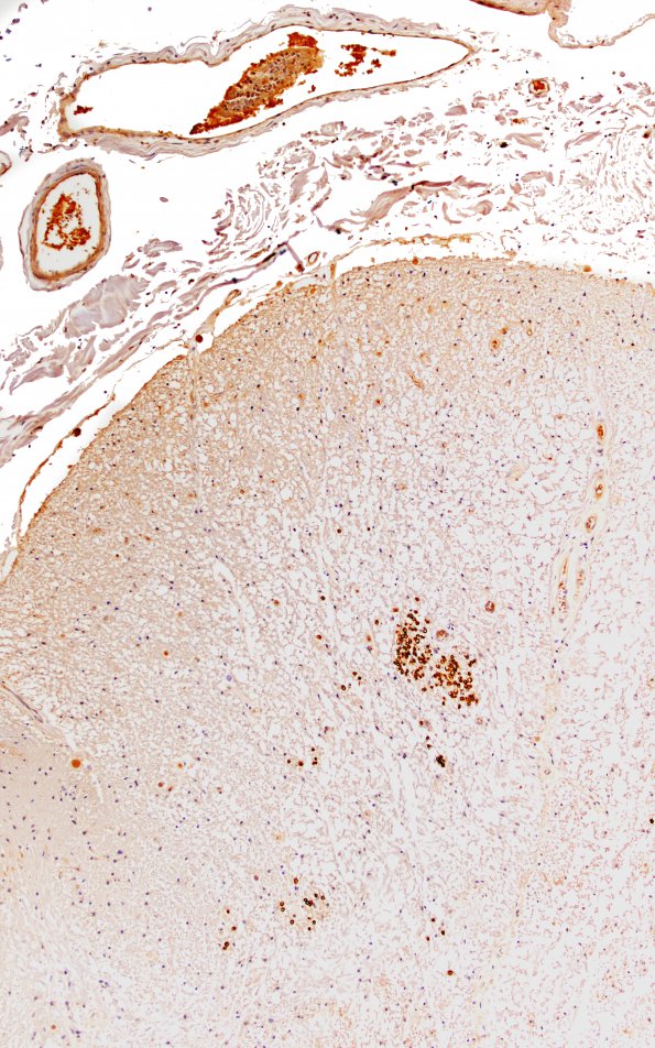 1B8 Schwannian Remyelination (Case 1) Po 10X match with A