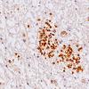 1B9 Schwannian Remyelination (Case 1) Po 40X