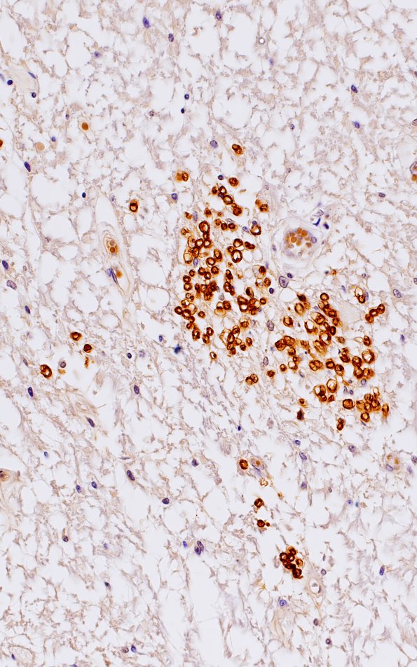 1B9 Schwannian Remyelination (Case 1) Po 40X