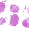 2A1 Multiple Sclerosis (Case 2) Active H&E whole mount