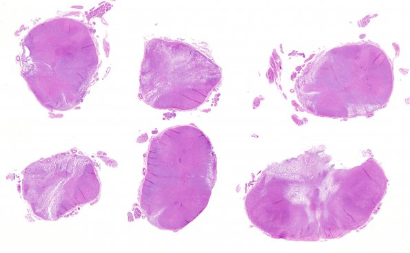 2A1 Multiple Sclerosis (Case 2) Active H&E whole mount