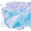 2A3 Multiple Sclerosis (Case 2) Active MS LFB-PAS 2X