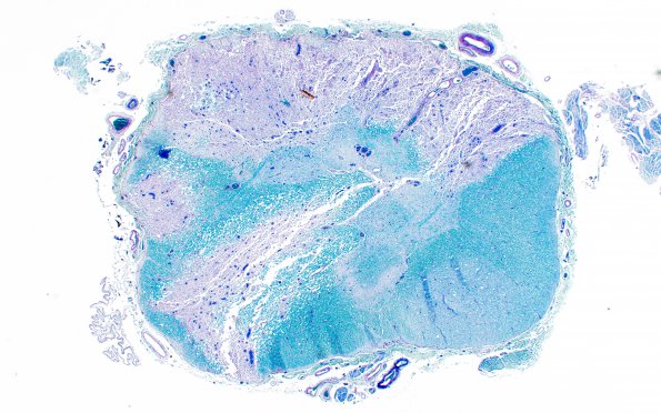 2A3 Multiple Sclerosis (Case 2) Active MS LFB-PAS 2X