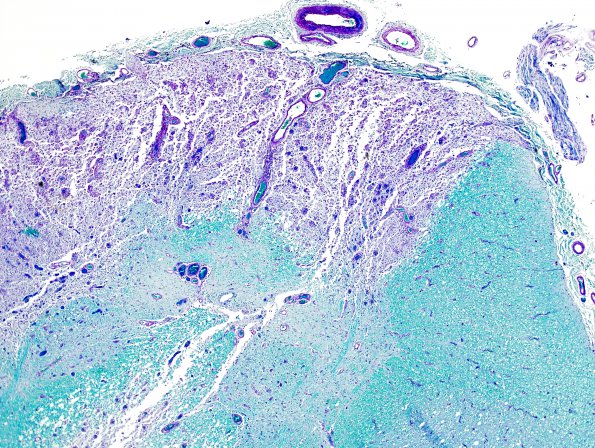 2A4 Multiple Sclerosis, Active (Case 2) Spinal Cord LFB-PAS 2