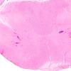 2B1 Multiple Sclerosis (Case 2) Active H&E A3