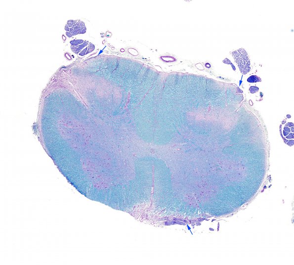 2B2 Multiple Sclerosis (Case 2) Active MS Schwann remyel LFB-PAS 5 copy