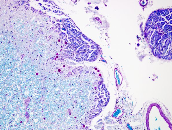 2B3 Multiple Sclerosis (Case 2) Active MS Schwann remyel LFB-PAS 8