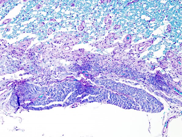 2B4 Multiple Sclerosis, Active (Case 2) LFB-PAS Schwann remyel 1A