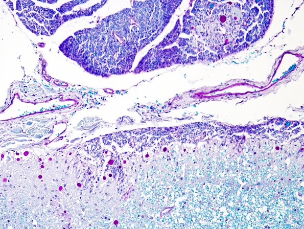 2B5 Multiple Sclerosis, Active (Case 2) LFB-PAS Schwann remyel 1