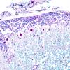 2B6 Multiple Sclerosis (Case 2) Active MS Schwann remyel LFB-PAS 16