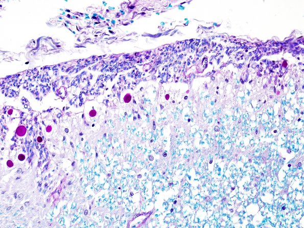 2B6 Multiple Sclerosis (Case 2) Active MS Schwann remyel LFB-PAS 16