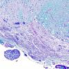 2B7 Multiple Sclerosis, Active (Case 2) LFB-PAS Schwann remyel 3