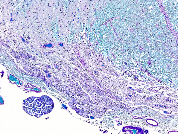 2B7 Multiple Sclerosis, Active (Case 2) LFB-PAS Schwann remyel 3