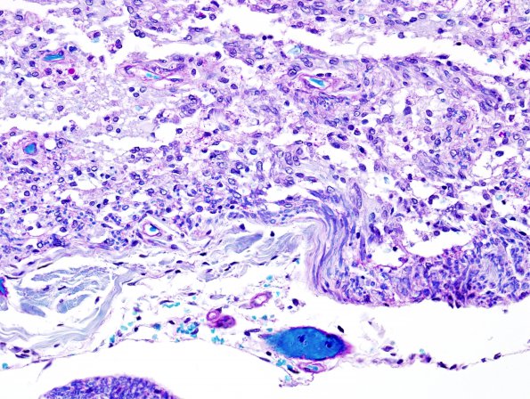 2B8 Multiple Sclerosis, Active (Case 2) LFB-PAS Schwann remyel 4