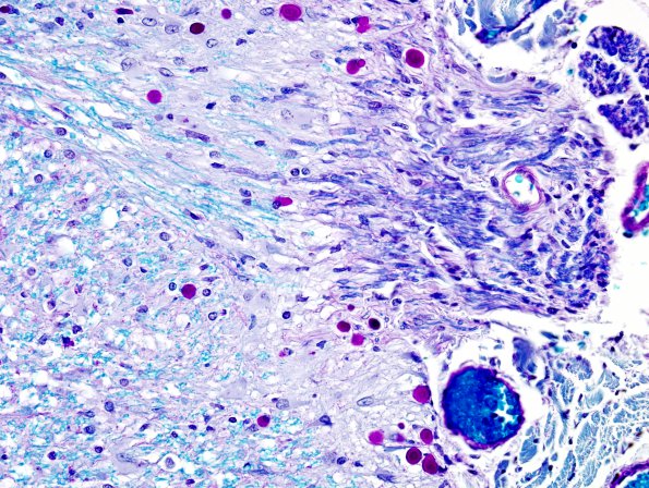 2B9 Multiple Sclerosis (Case 2) Active MS Schwann remyel LFB-PAS 14