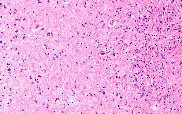 3D5 MS (Case 3) N14 Schwann remyelination Area A H&E 20X