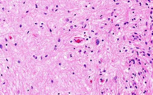 3D6 MS (Case 3) N14 Schwann remyelination Area A H&E 40x