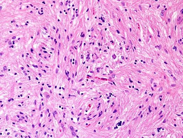 3D7 MS (Case 3) N14 Schwann remyelination H&E 2