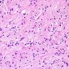 3D8 MS (Case 3) N14 Schwann remyelination Oligo mixed H&E 1