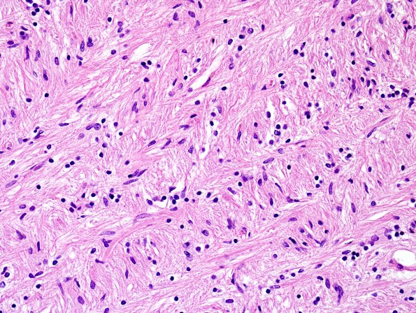 3D8 MS (Case 3) N14 Schwann remyelination Oligo mixed H&E 1