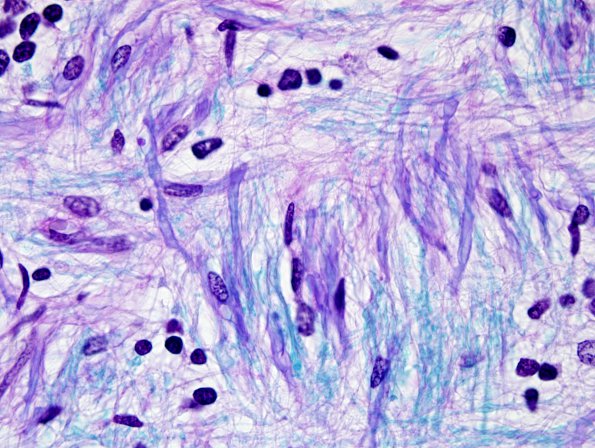 3E11 MS (Case 3) N14 Schwann remyelination LFB-PAS 100X 6