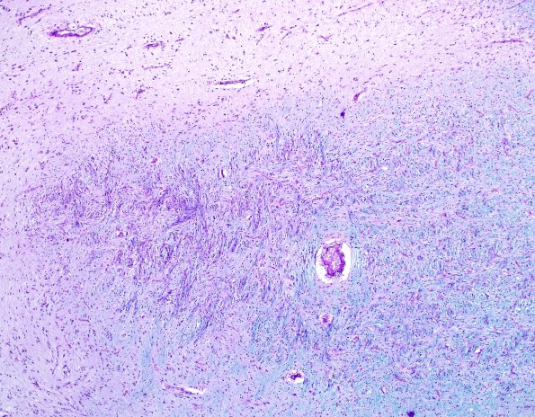 3E2 MS (Case 3) N14 Schwann remyelination LFB-PAS 5