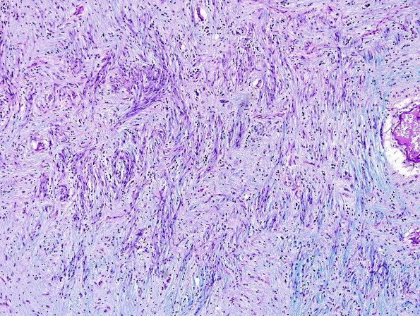 3E3 MS (Case 3) N14 Schwann remyelination Area A LFB-PAS 10X