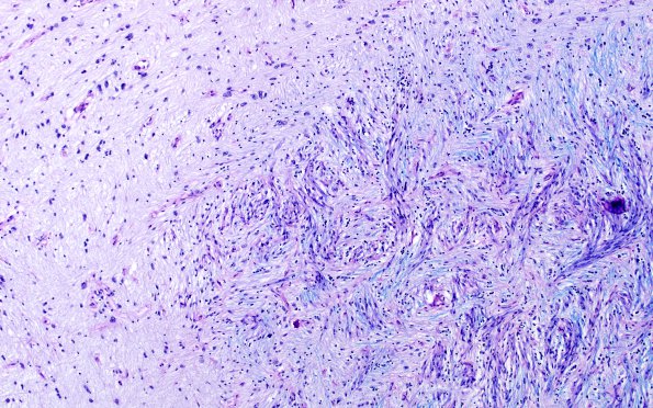 3E4 MS (Case 3) N14 Schwann remyelination Area A LFB-PAS 10X