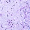 3E5 MS (Case 3) N14 Schwann remyelination Area A LFB-PAS 20X