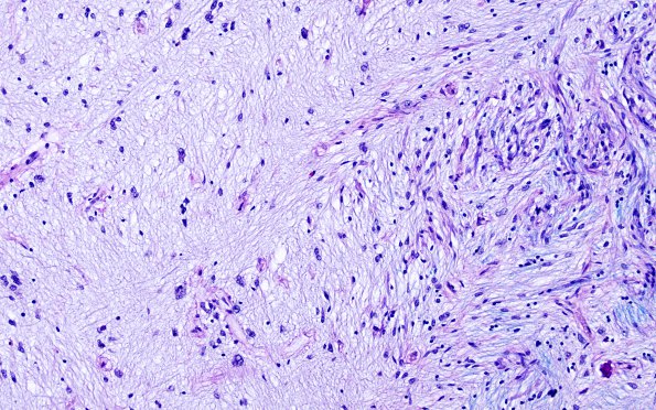 3E5 MS (Case 3) N14 Schwann remyelination Area A LFB-PAS 20X