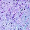 3E6 MS (Case 3) N14 Schwann remyelination LFB-PAS 1