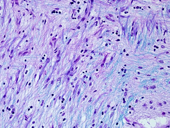 3E6 MS (Case 3) N14 Schwann remyelination LFB-PAS 1