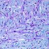 3E7 MS (Case 3) N14 Schwann remyelination LFB-PAS 3