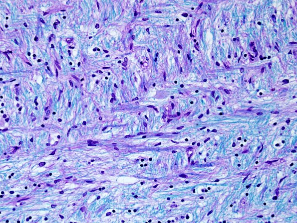 3E7 MS (Case 3) N14 Schwann remyelination LFB-PAS 3