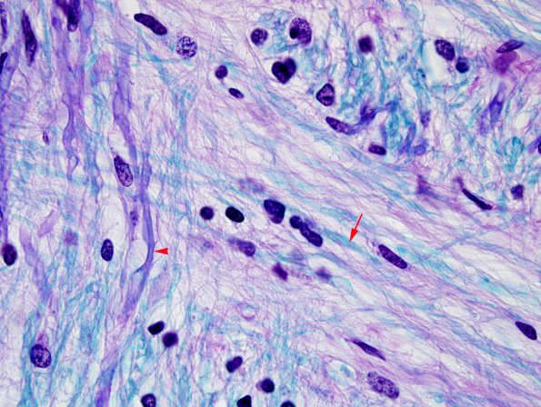 3E8 MS (Case 3) N14 Schwann remyelination LFB-PAS 100X 1 copy copy