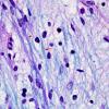 3E9 MS (Case 3) N14 Schwann remyelination LFB-PAS 100X 2 copy