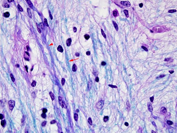 3E9 MS (Case 3) N14 Schwann remyelination LFB-PAS 100X 2 copy