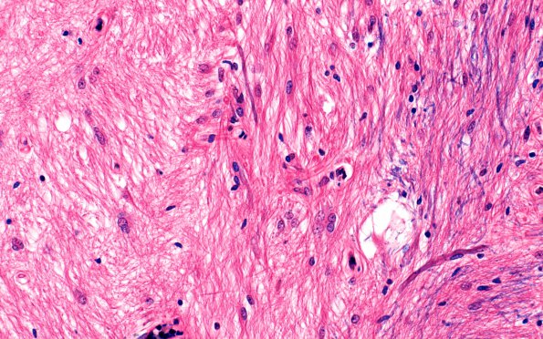 3F2 MS (Case 3) N14 Schwann remyelination Area A H&E 40X 2