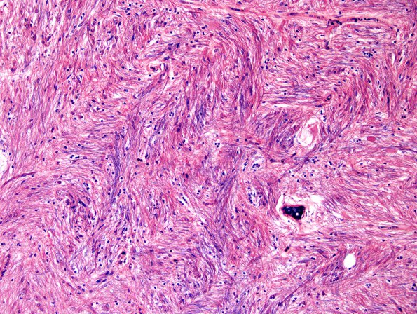 3F3 MS (Case 3) N14 Schwann remyelination Solochrome cyanin 20X