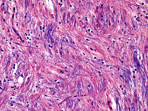 3F4 MS (Case 3) N14 Schwann remyelination Solochrome cyanin 40X