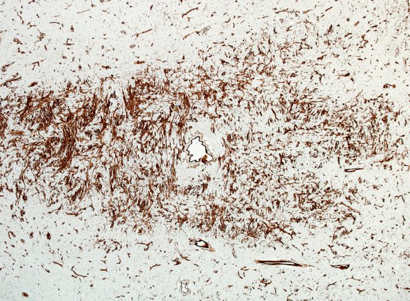 3I1 MS (Case 3) N14 Schwann remyelination Area A Coll IV 4x
