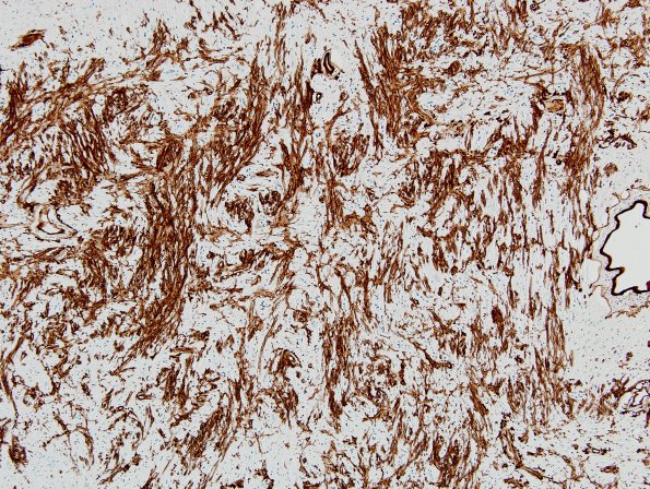 3I2 MS (Case 3) N14 Schwann remyelination Area A Coll IV 10x