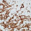 3I3 MS (Case 3) N14 Schwann remyelination Coll IV mixed Oligo-Schwann 2